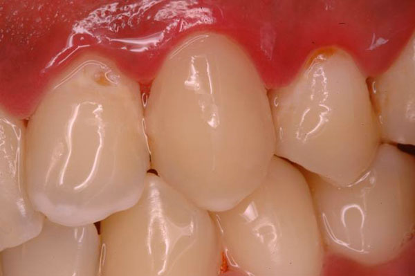 Restorations of Cervical defects