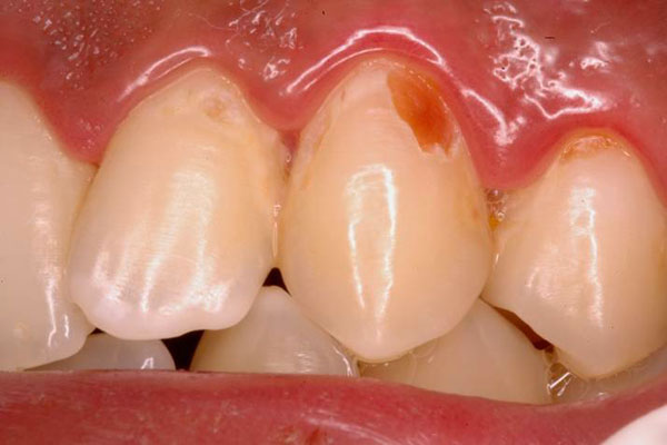 Restorations of Cervical defects