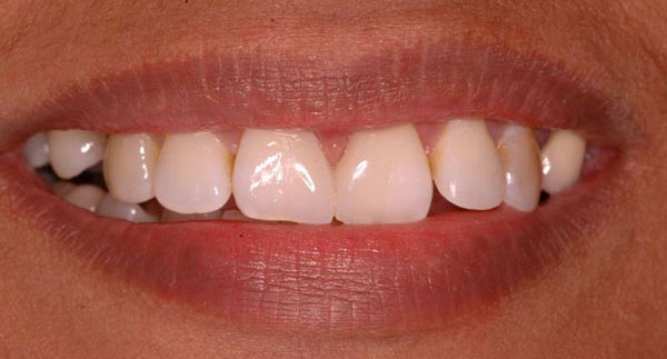 Correction of Midline Diastema Post