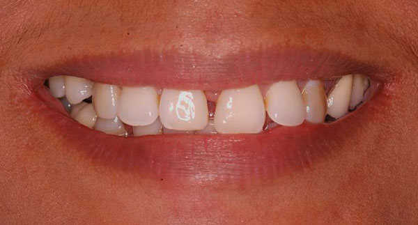 Correction of Midline Diastema Pre