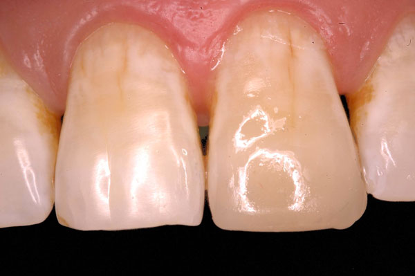 Esthetics with Anterior Restorations