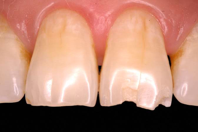 Esthetics with Anterior Restorations