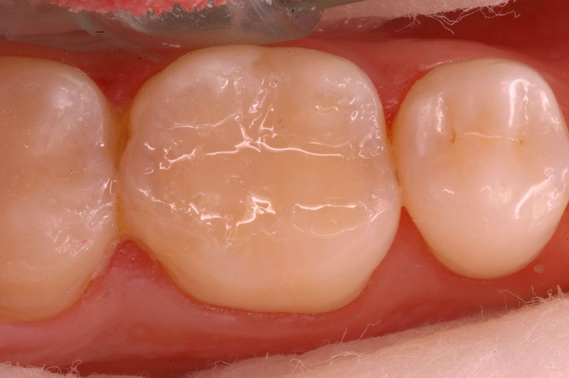 Posterior Restorations