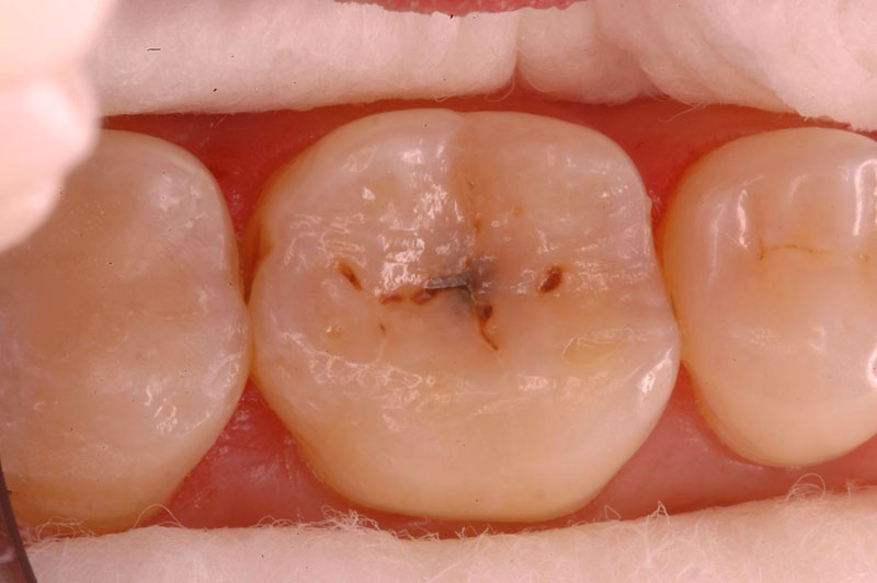 Posterior Restorations